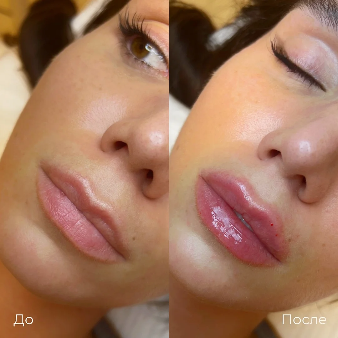 Уколы в губы фото