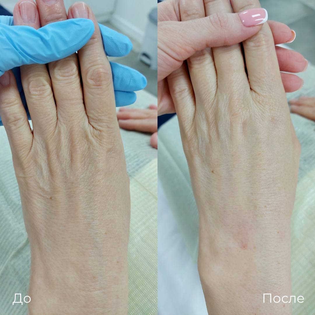 Омоложение кожи рук фото 3