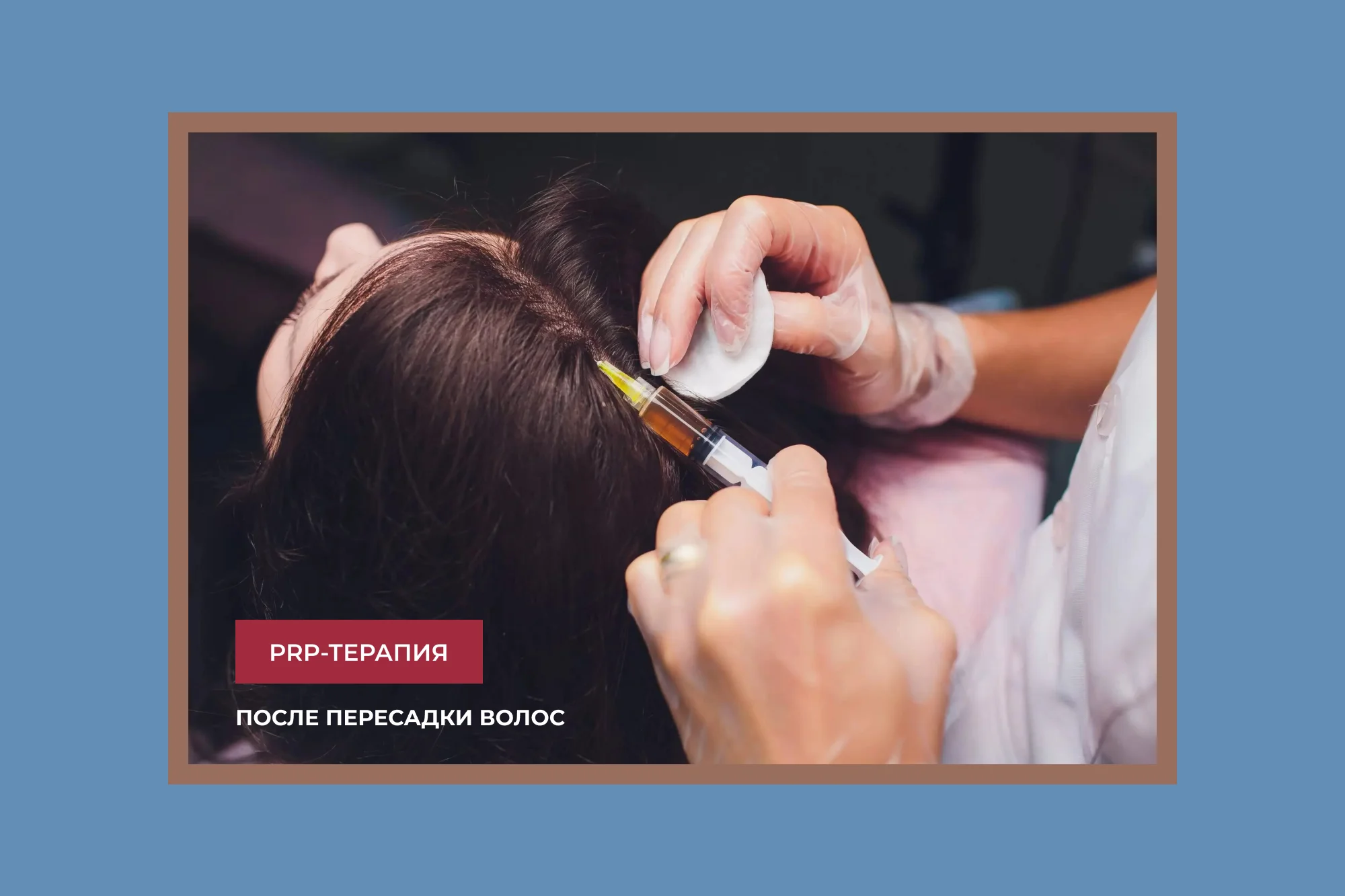 PRP-терапия после пересадки волос
