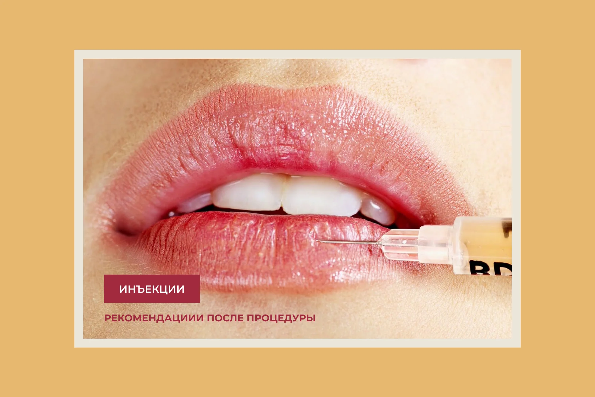 15 вещей, которые не следует делать после косметологических инъекций