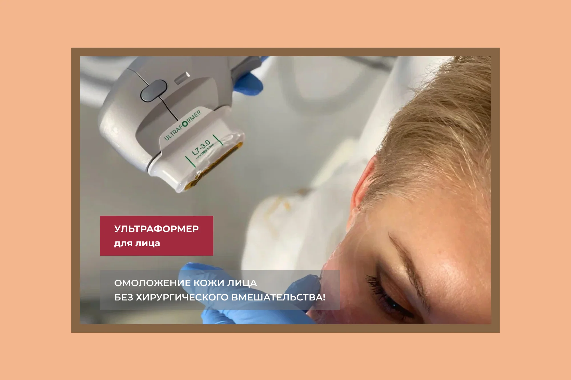 Безоперационная подтяжка лица на аппарате Ultraformer 3