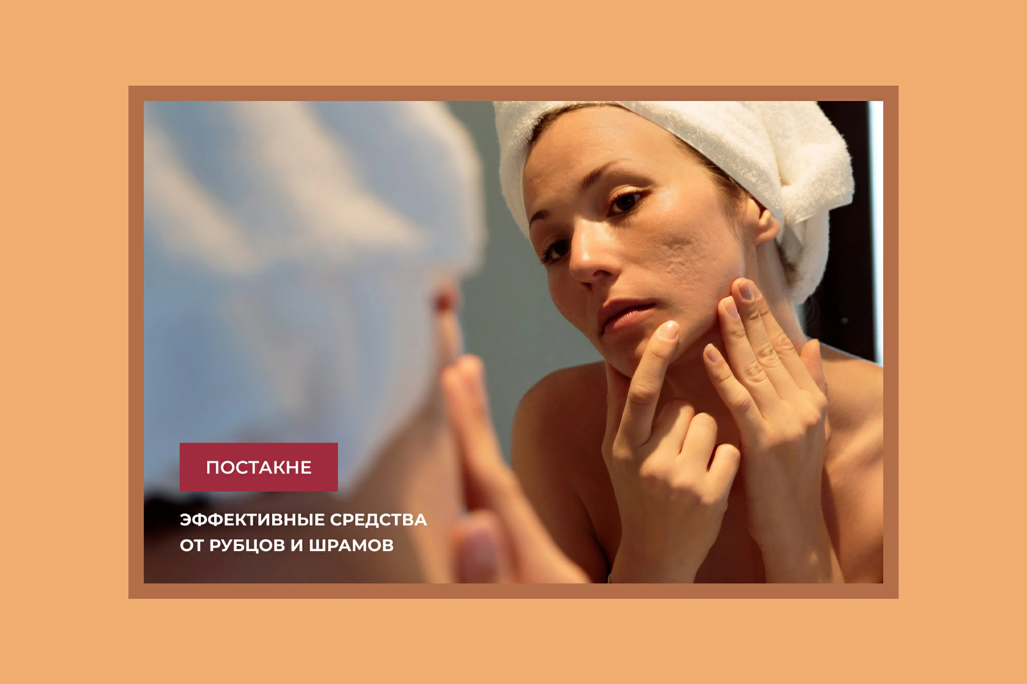 Как навсегда избавиться от постакне?