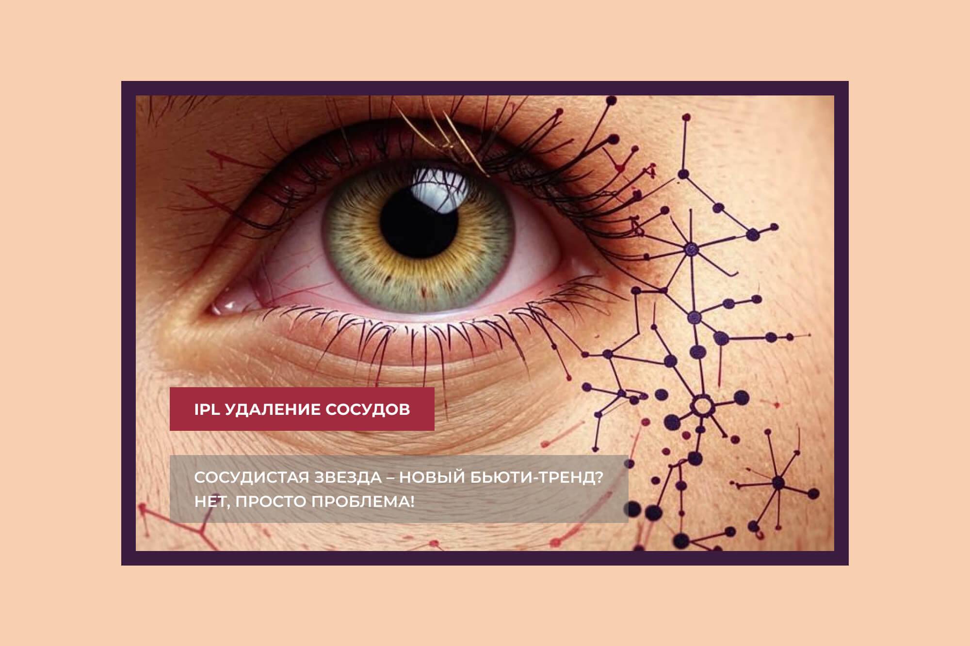 Фототерапия сосудов IPL