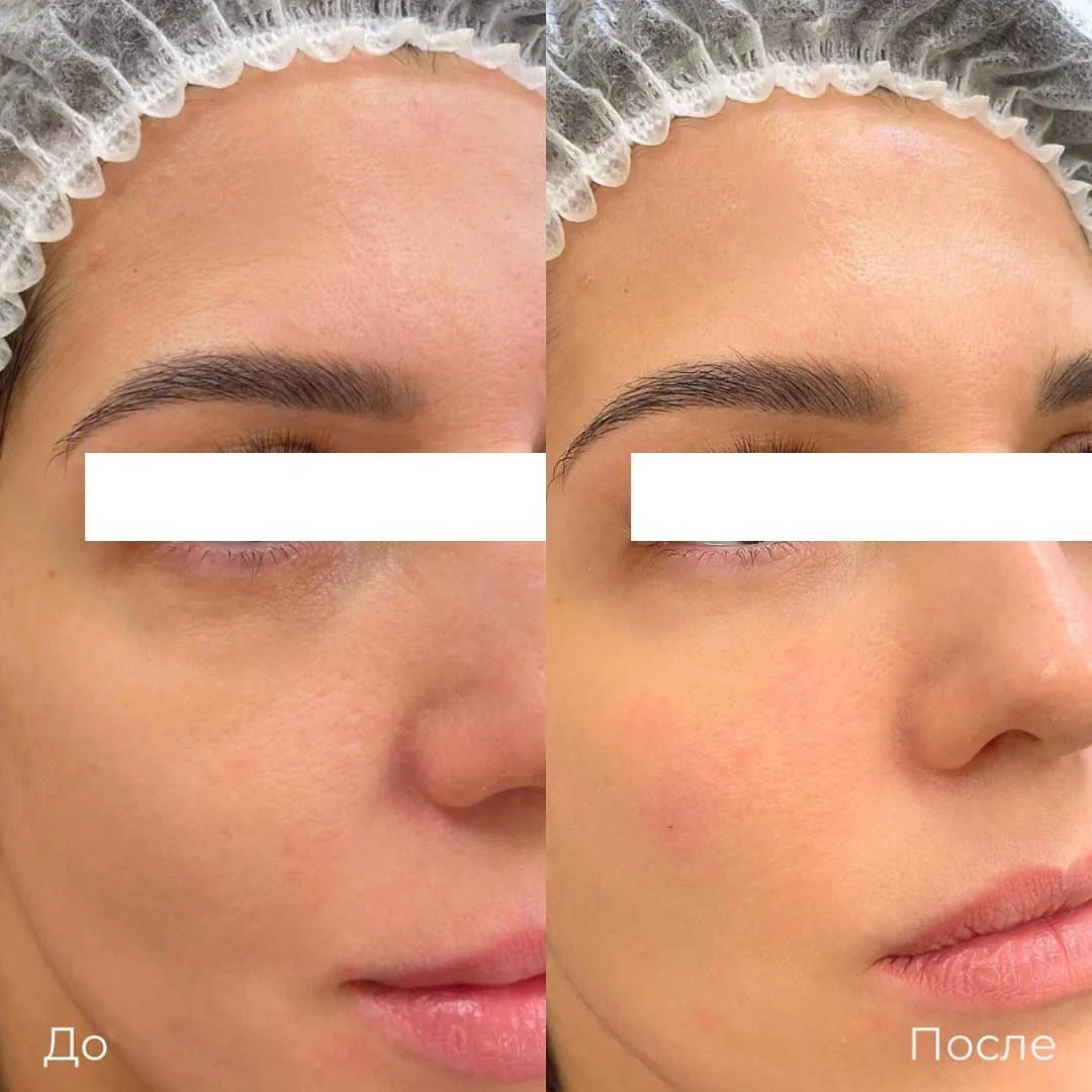 Фото до и после коррекции носослёзной борозды