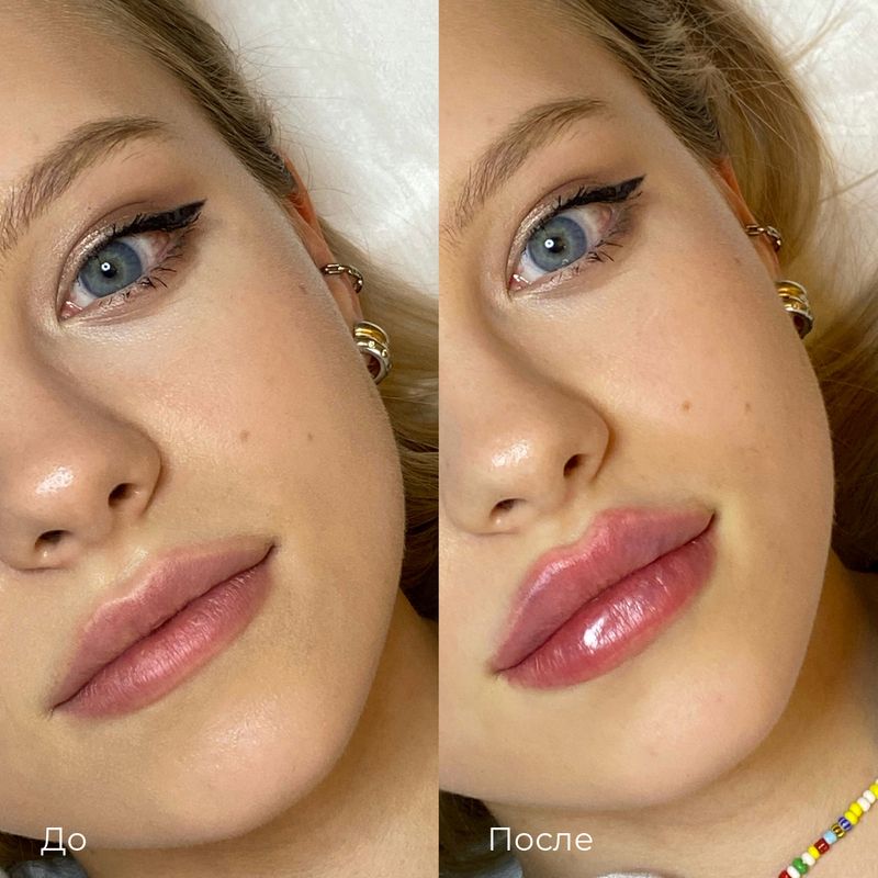 Губы: до и после процедуры