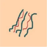рис. Линейные телеангиэктазии